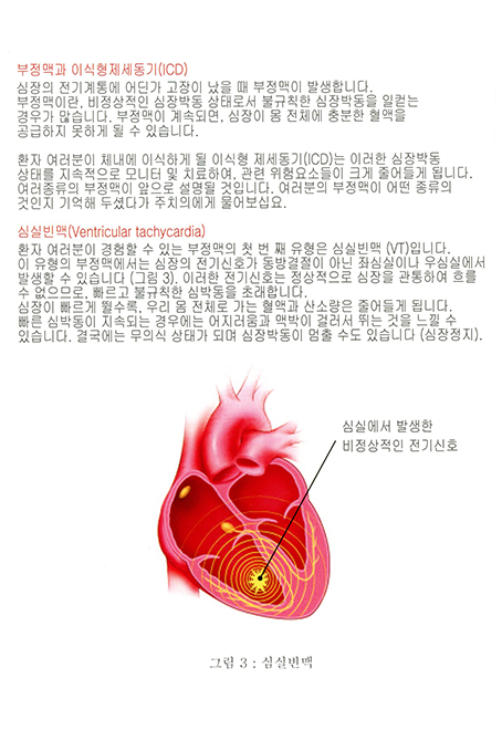 1.부정맥과 이식형제세동기